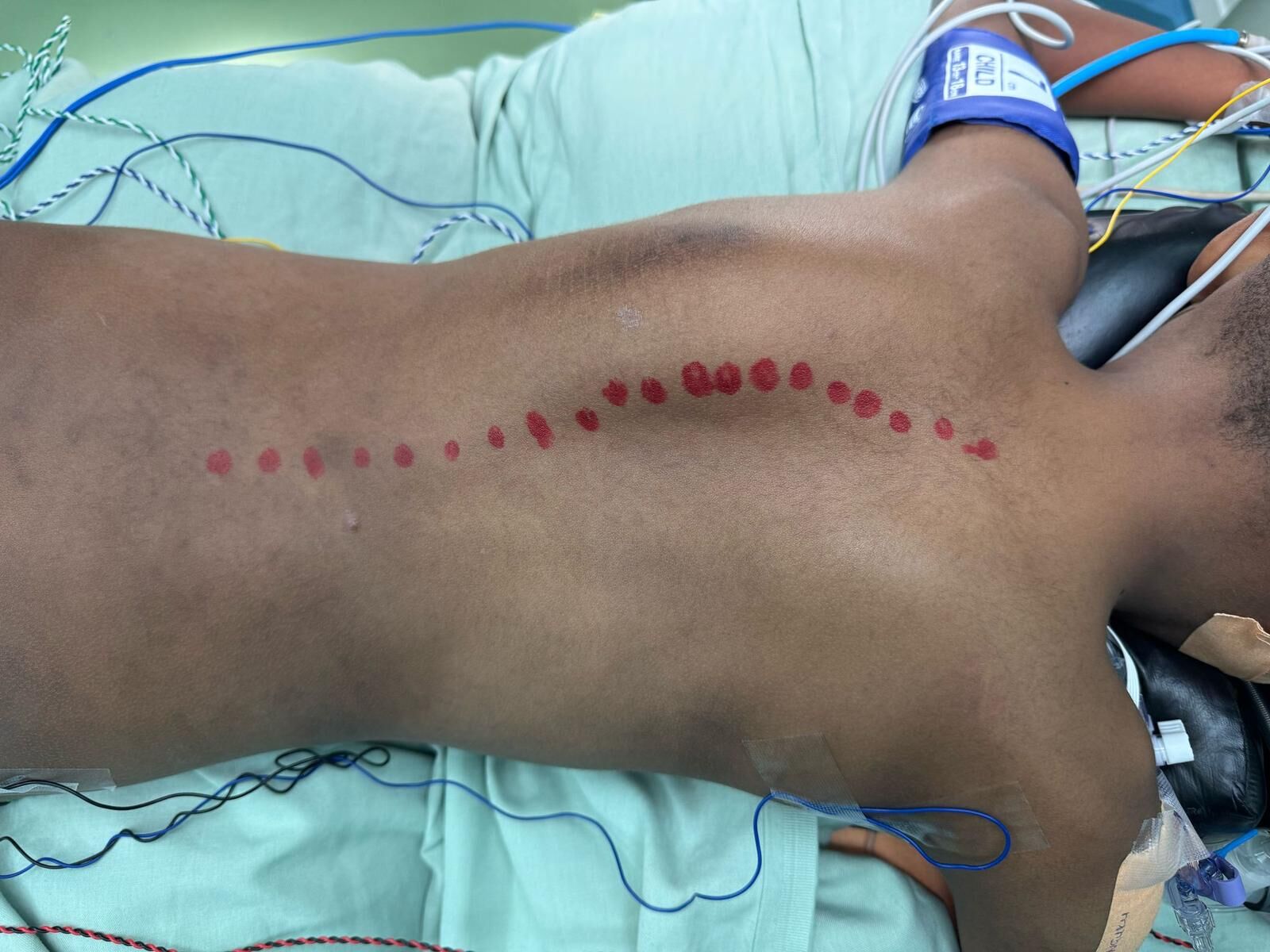 Understanding Scoliosis in Children – Causes, Signs & When to Seek Help. Guide From Dr Sandesh Lakkol