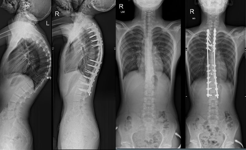 Best Surgeon in Abu Dhabi for Kyphosis Correction – Dr. Sandesh Lakkol on Principles of Spinal Deformity Surgery